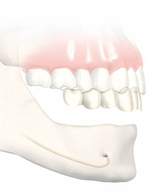 L'extraction dentaire – préservation osseuse avant la mise en place d'un  implant dentaire Le Perreux sur Marne (94170)